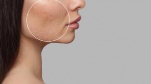 Niacinamida în melasmă: Cum reglezi excesul de melanină?