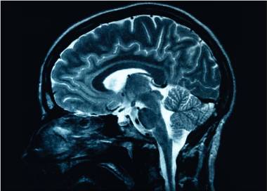 Leziunile cerebrale cauzate de Alzheimer ar putea fi reversibile, în urma unei noi descoperiri genetice