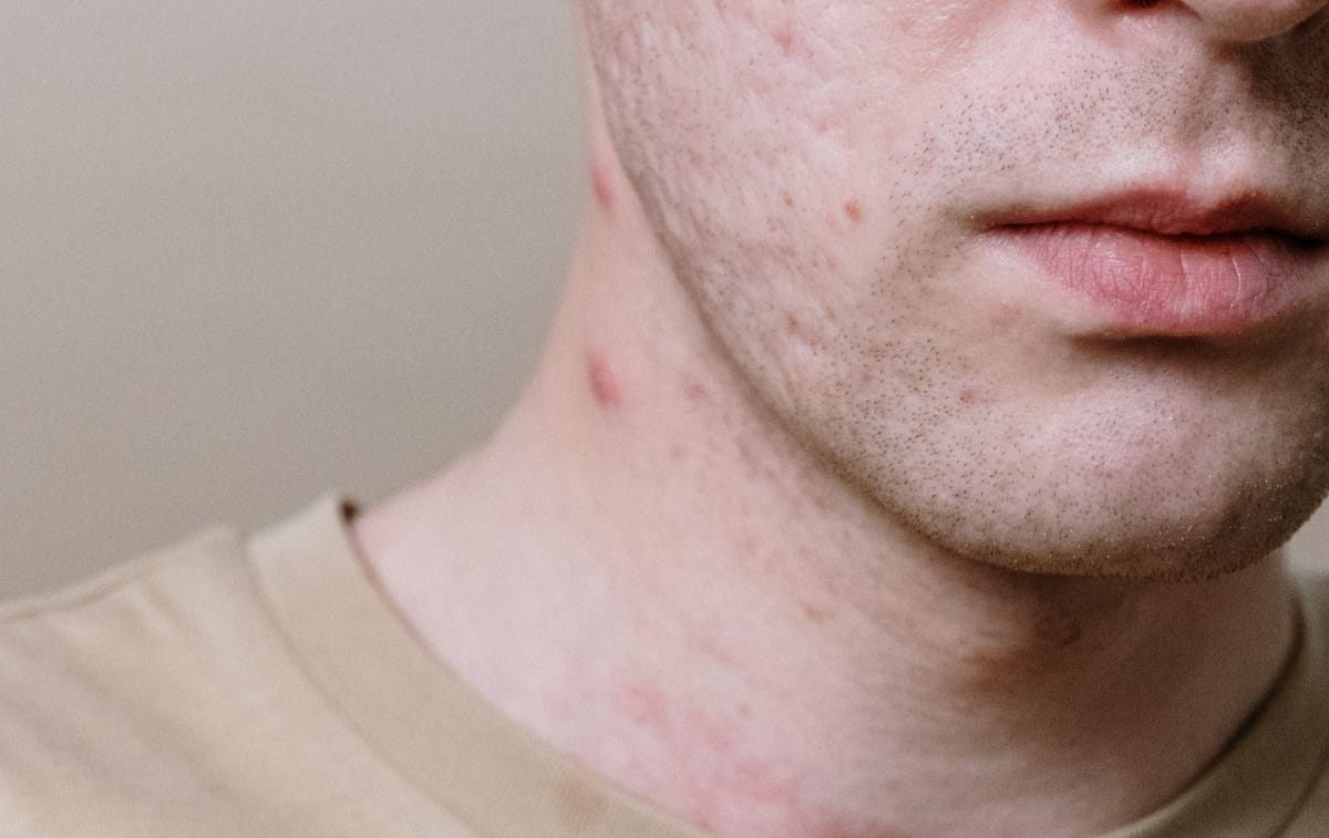 Acneea revine la adulți: de ce nu trebuie stoarse coșurile și ce se întâmplă cu pielea după 25 de ani